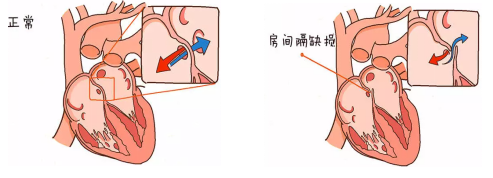 仅次于室间隔缺损,是胚胎发育期心房间隔上残留未闭的缺损而形成